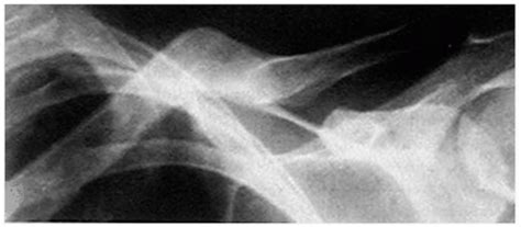 Fractures of the Upper Extremity | Musculoskeletal Key