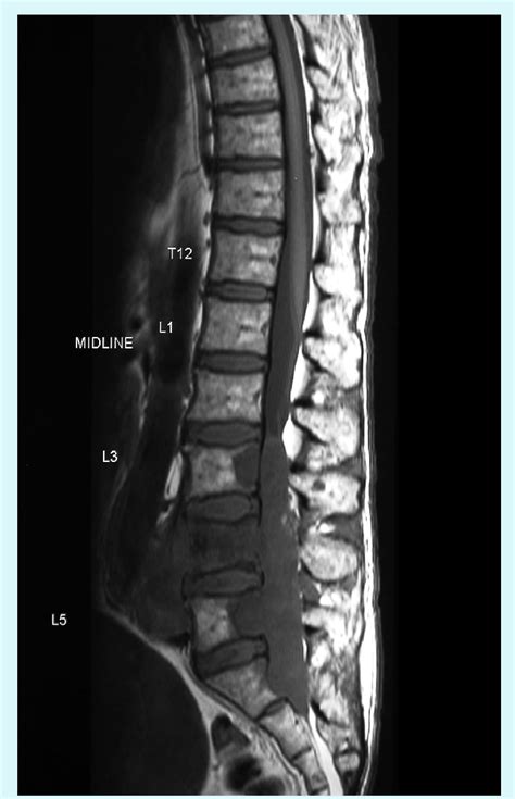 T1 Sagittal Hypointense Lobulated Soft Tissue Mass Located In Spinal