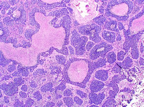 Large Cell Neuroendocrine Carcinoma This Low Magnification Flickr