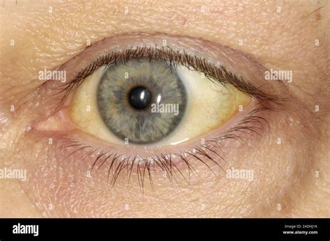 Alcoholic Jaundice Close Up Of The Eye Of A 48 Year Old Woman Showing