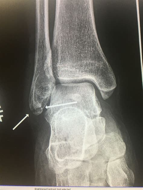 Avulsion Fracture Ankle Lateral Malleolus Find All The Fractures