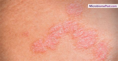 Common Skin Conditions Nhs 260