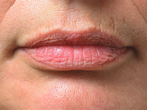 Pictures Of Purple Spots On Lips