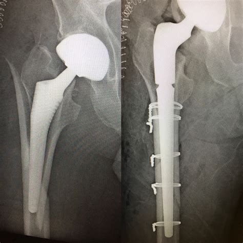 Hip Revision Surgery Denver Revision Hip Replacement Denver