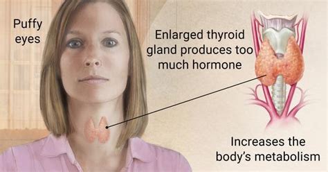 Hipertiroid Gejala Penyebab And Cara Mengobatinya Info Kesehatan