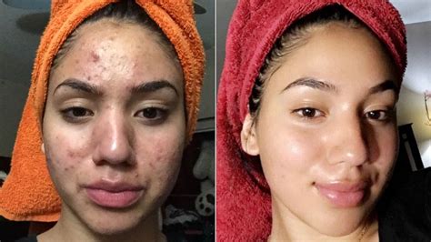 Acne Before And After