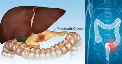Pancreatic cancer (ductal adenocarcinoma of the pancreas) in the early stages typically causes vague nonspecific symptoms. 15 Facts And Symptoms Of Pancreatic Cancer You Should ...