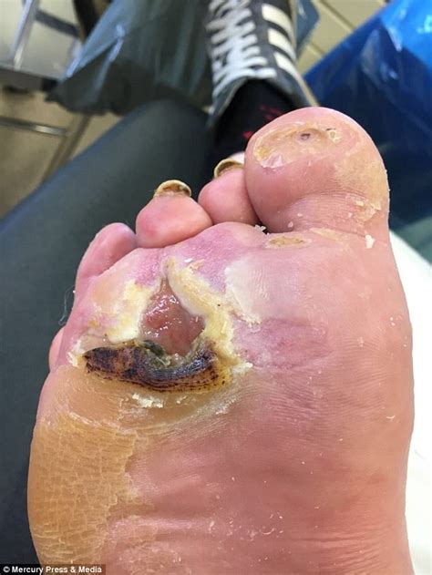 Mans Foot With Giant Burn Hole Saved By Maggots Daily