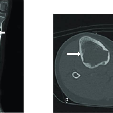 8 Years Old Boy With Unicameral Bone Cyst Of Distal Femur A