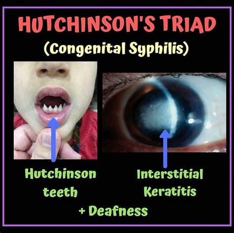 Congenital Syphilis Ophthalmology Notes And Synopses