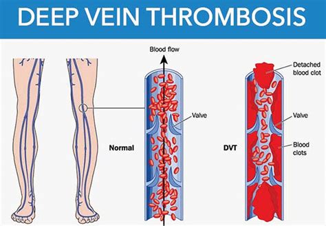 Dvt Deep Vein Thrombosis Signs Symptoms Prophylaxis And Treatment