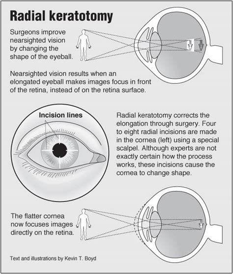 Radial Keratotomy Pointfinder Health Infographics