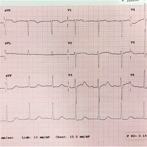 ECG Showing A Normal Sinus Rhythm With A Prolonged PR Interval A