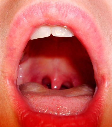 Tonsils You See How You Can See The Back Of My Throat You Flickr