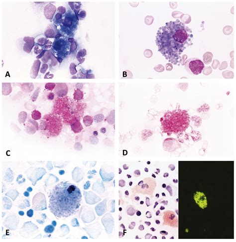 Images From The Haematologica Atlas Of Hematologic Cytology Sea Blue
