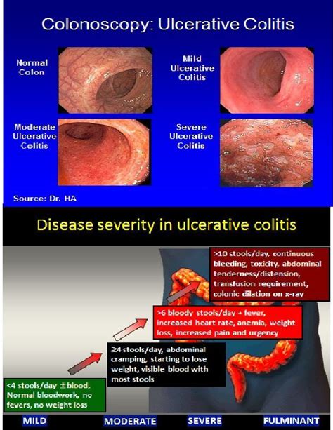 Side By Side Comparison Of Ulcerative Colitis Colonoscopy View With