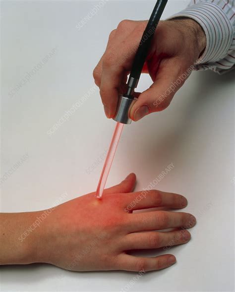 Paterson Lamp Used To Treat Skin Cancer On A Hand Stock Image M705