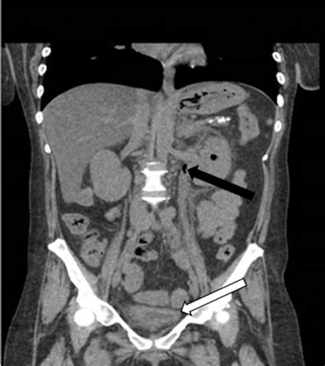 Cureus Case Report Of An Atypical Abdominal Pain Found To Be A Rare