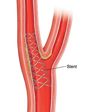 Carotid Stenting NCH Healthcare System