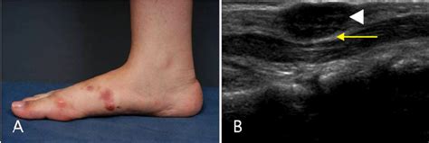 A A Painful Erythematous Nodule Was Found On The Arch Of The Foot