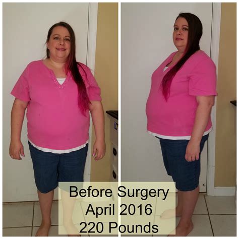 Gastric Sleeve Weight Loss Before And After Weight Loss Wall