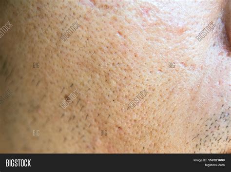 Close Acne Acne Holes Welded On Image And Photo Bigstock