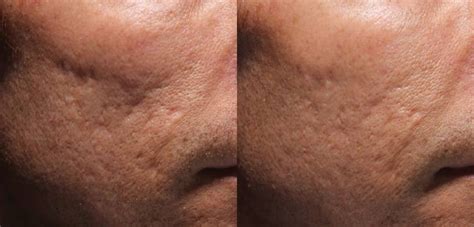 Acne And Large Pores Treatment Baltimore Md