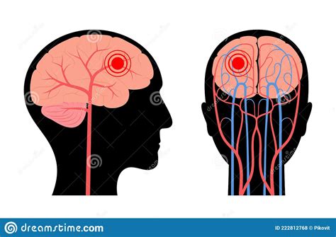 Hersenpijn Ziekte Vector Illustratie Illustration Of Vlak 222812768