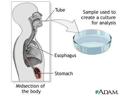 Culture Of Gastric Tissue Biopsy MedlinePlus Medical Encyclopedia Image