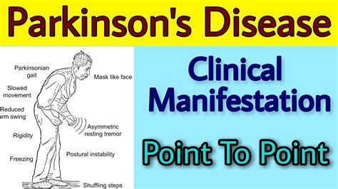 Parkinsons Disease Clinical Manifestation Delirium Dementia