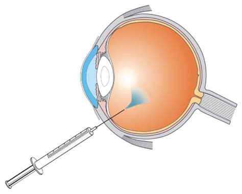 Stick A Needle In My Eye Intravitreal Steroid Implant Injection