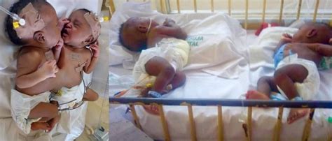 Nigerian Doctors Separate Conjoined Twins In Abuja Photo