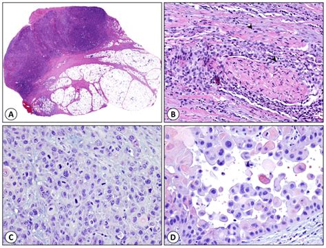 Cutaneous Squamous Cell Carcinomas Focus On High Risk Features And
