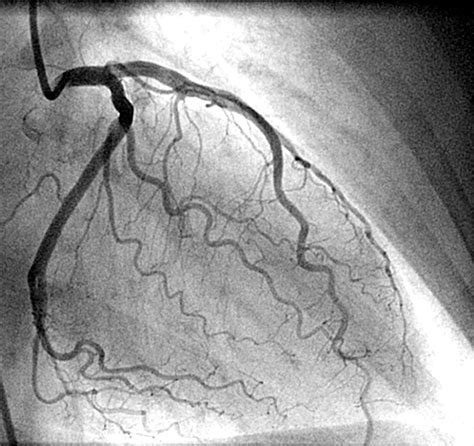 Why Is A Coronary Angiogram Alone Not Enough To Make A Diagnosis Of