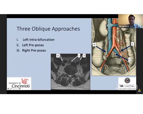 Approaches To Oblique Lumbar Interbody Fusion —