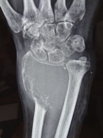 Giant Cell Tumor Of Bone Radiology Reference Article Radiopaedia Org