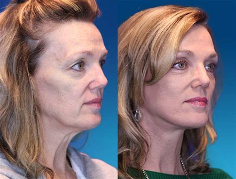 Before And After Facelift Photos Youthful Reflections Laser Skin