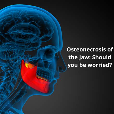 Osteonecrosis Of The Jaws Should You Be Worried