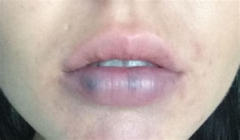 Hemangioma Of The Lip A Purple Spot On The Lip My Best Dentists
