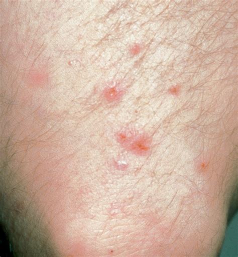 Dermatitis Herpetiformis Diseases And Conditions 5minuteconsult