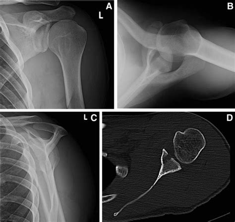 Arthroscopic Fixation Of Glenoid Rim Fractures After Reduction By