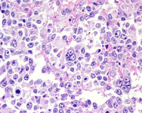 Diffuse Large B Cell Lymphoma Anaplastic Variant 3