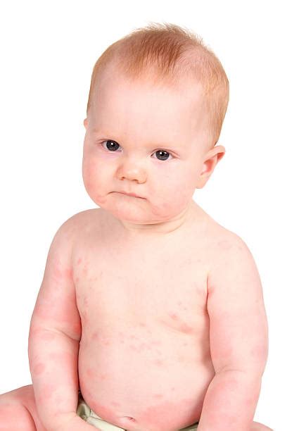 Diaper Rash Stock Photos Pictures And Royalty Free Images Istock