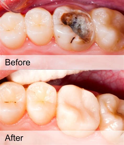 Tooth Cavity Filling Treatment Matrix Dental And Skin Lounge