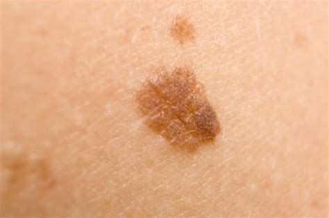 916skin Acne Skin And Wellness Clinic Skin Cancer Concerns For Acne
