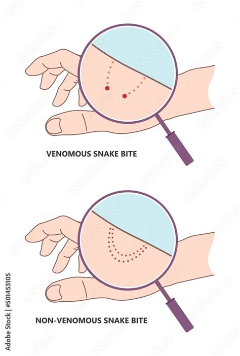 Snake Bite First Aid Care Non Venomous Anti Venom Serum Hand Leg King