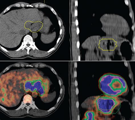 Esophageal Cancer Radiology Key