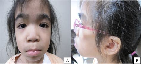 Meaning of epicanthal folds medical term. Flat Nasal Bridge And Epicanthal Folds : Lower nose bridge ...