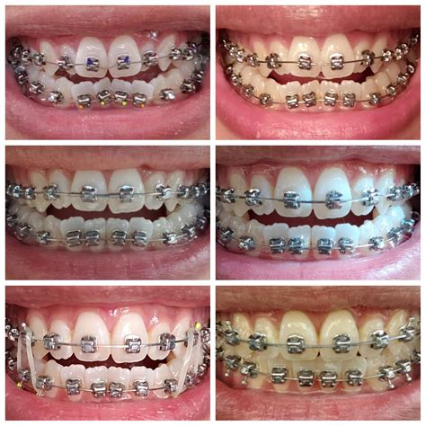 damon braces progress day one and six week adjustments braces