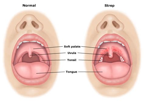 strep throat symptoms causes treatment pictures home remedies healthmd